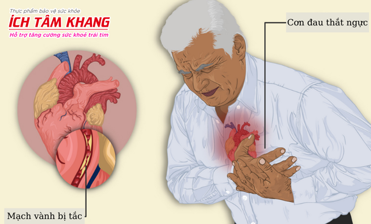 Cơn đau thắt ngực là dấu hiệu điển hình cảnh báo bệnh mạch vành